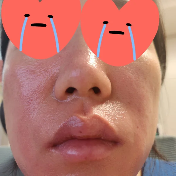 입 주변 구순염·붉은기 개선 포토리뷰